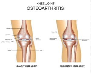 Knee Arthritis