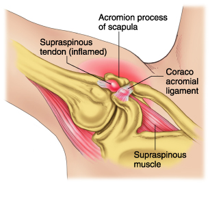 shoulder impingement diagnosis