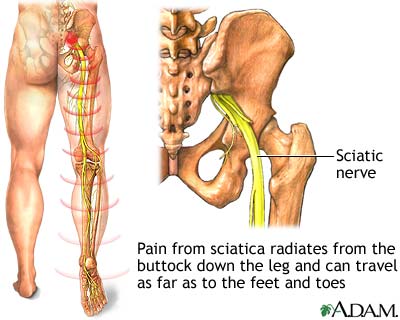 Sciatica Hip Pain Causes, Treatment Los Angeles, Beverly Hills, Santa  Monica CA