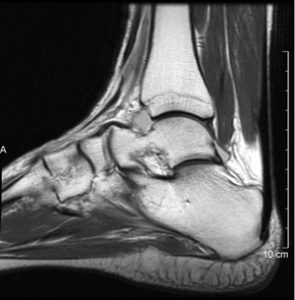 (PRP) and Stemcell Therapy for Cronic Ankle Pain by Dennis M. Lox MD