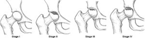 Avascular Necrosis Explained by a Tampa Bay Doctor