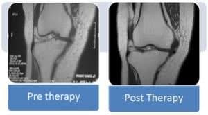 Before and After Stem Cell Therapy