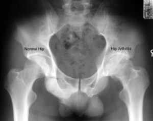 Arthritis of the HIp