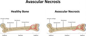 Avascular Necrosis