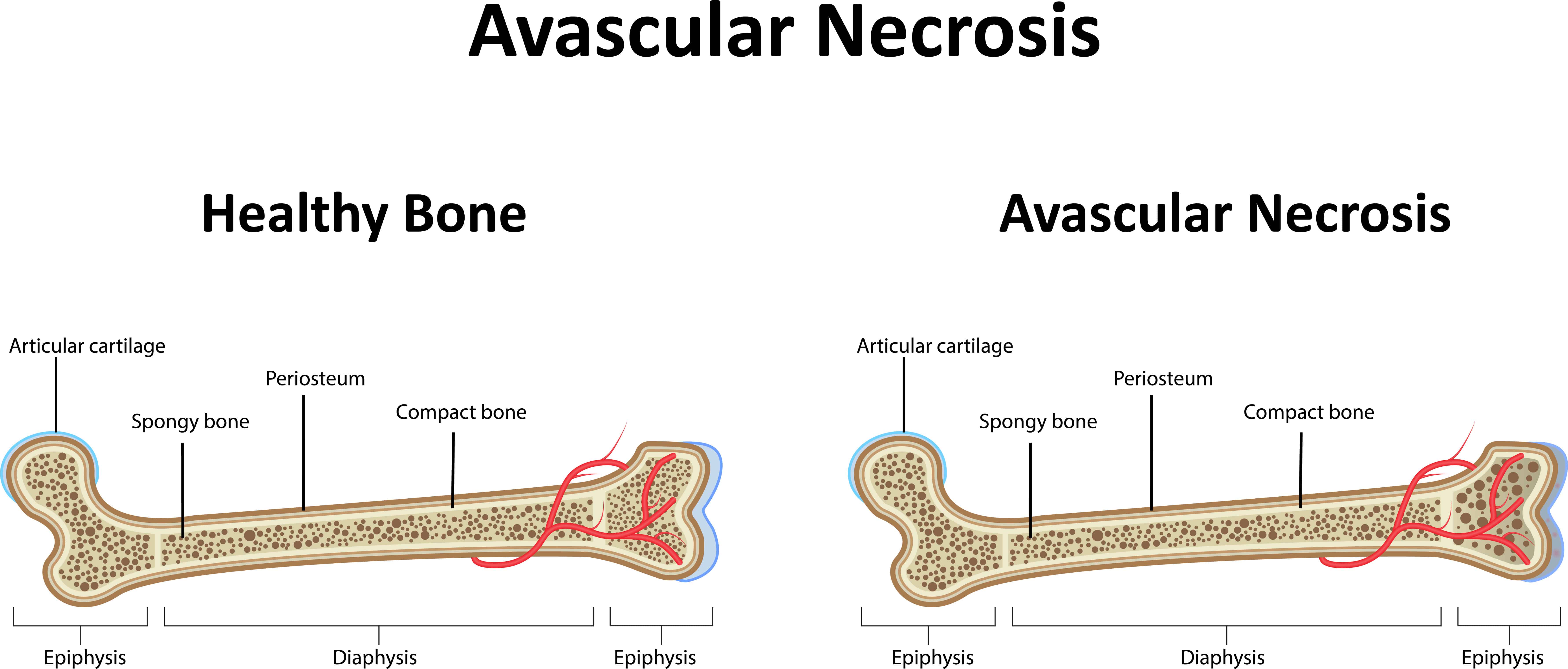 Dr. Lox on AVN New Treatments with Regenerative Medicine - Dr