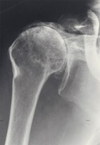Severe shoulder arthritis, Dr. Lox