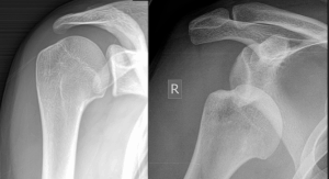 Shoulder dislocation