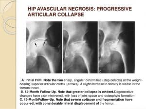 hip avn