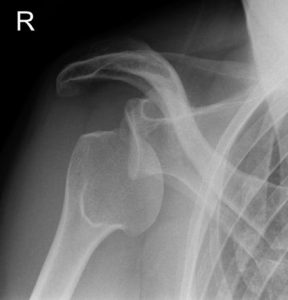Shoulder dislocation