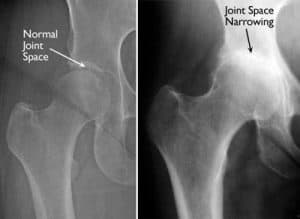 hip arthritis dr. lox
