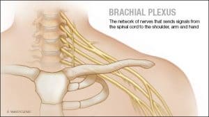 brachial plexus injury