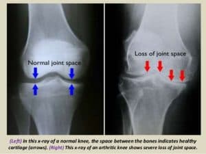 knee pain from osteoarthritis