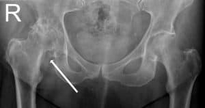 hip arthritis dr. lox