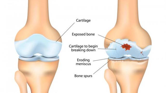 knee osteoarthritis