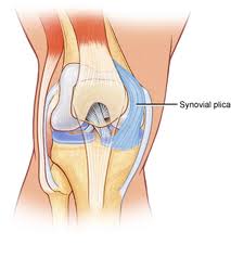 Knee Plica Syndrome