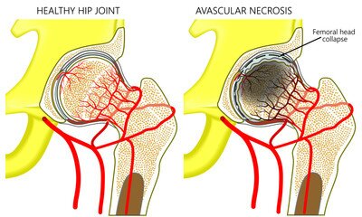 Petition · AVN - RAISE AWARENESS OF AVASCULAR NECROSIS ·