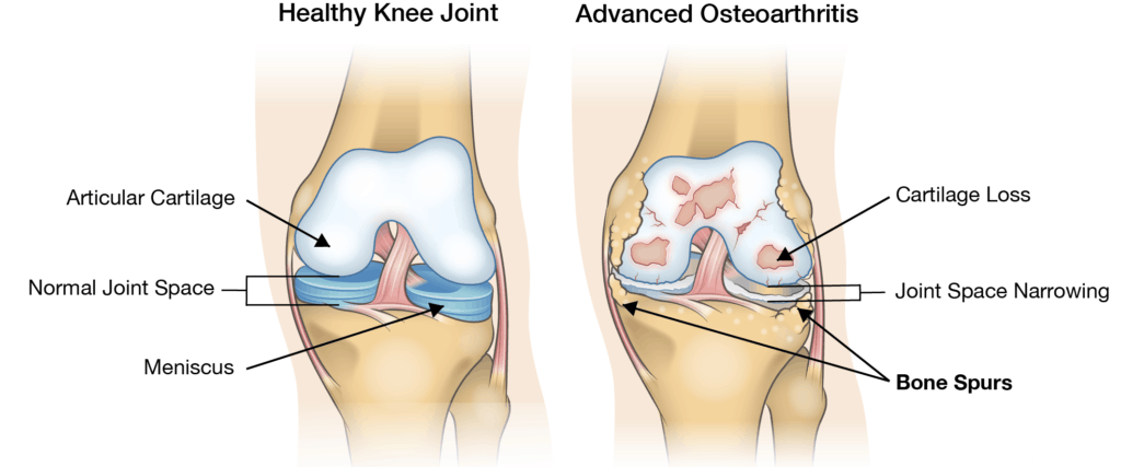 https://www.drlox.com/wp-content/uploads/2019/11/knee-arthritis.png