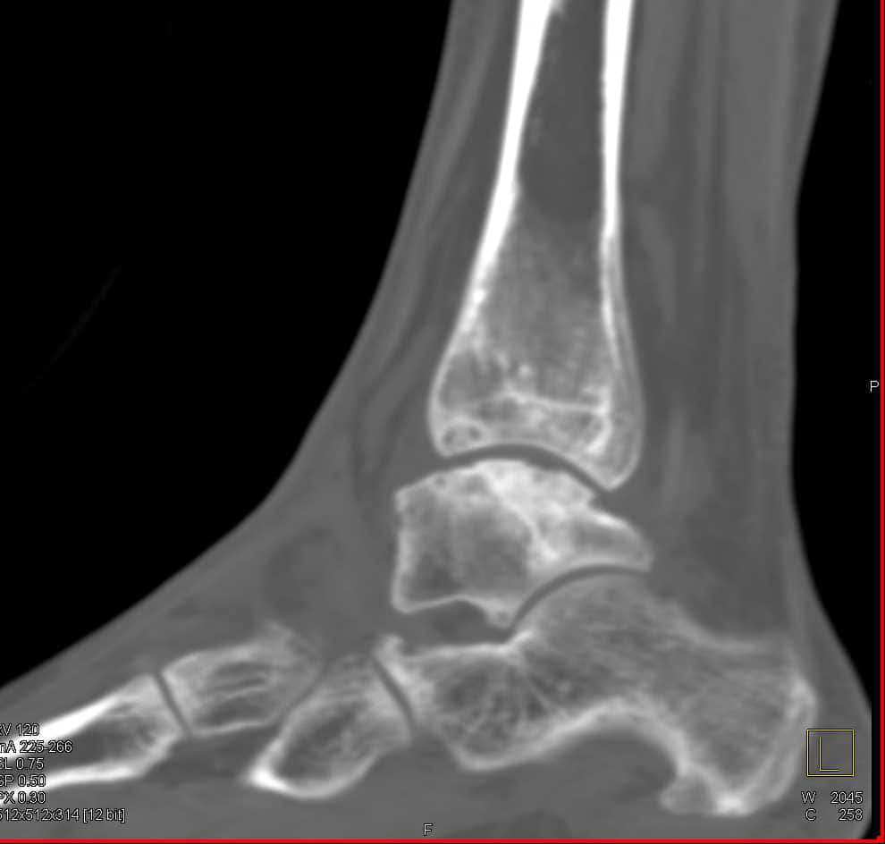 Ankle AVN and Ankle Joint Replacement or Fusion Alternatives - Dr. Lox